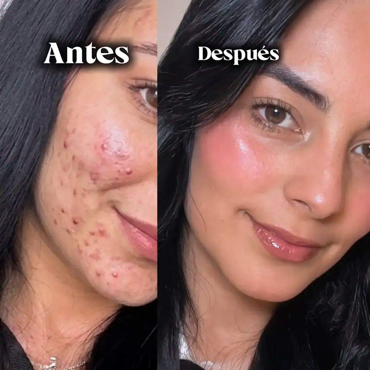 Crema Origen Facial - Tu Solución Definitiva contra el Acné