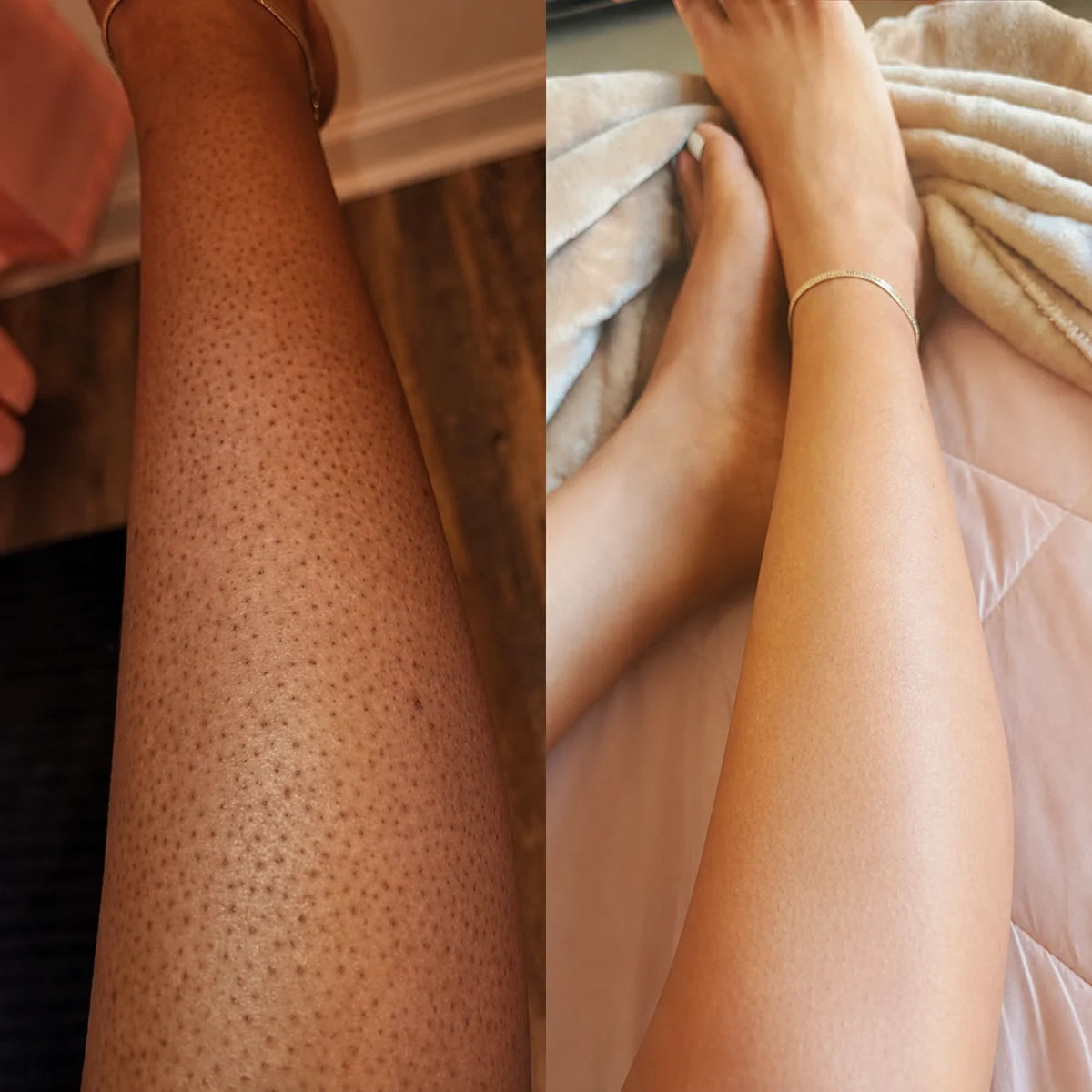 DERMAPURA® – Recuperá una piel lisa y libre de granitos.
