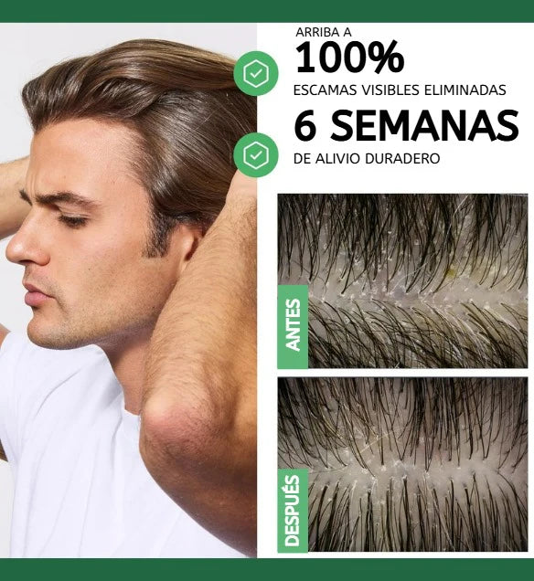 SHAMPOO DERCOS - DILE ADIOS A LA CASPA DESDE EL PRIMER USO