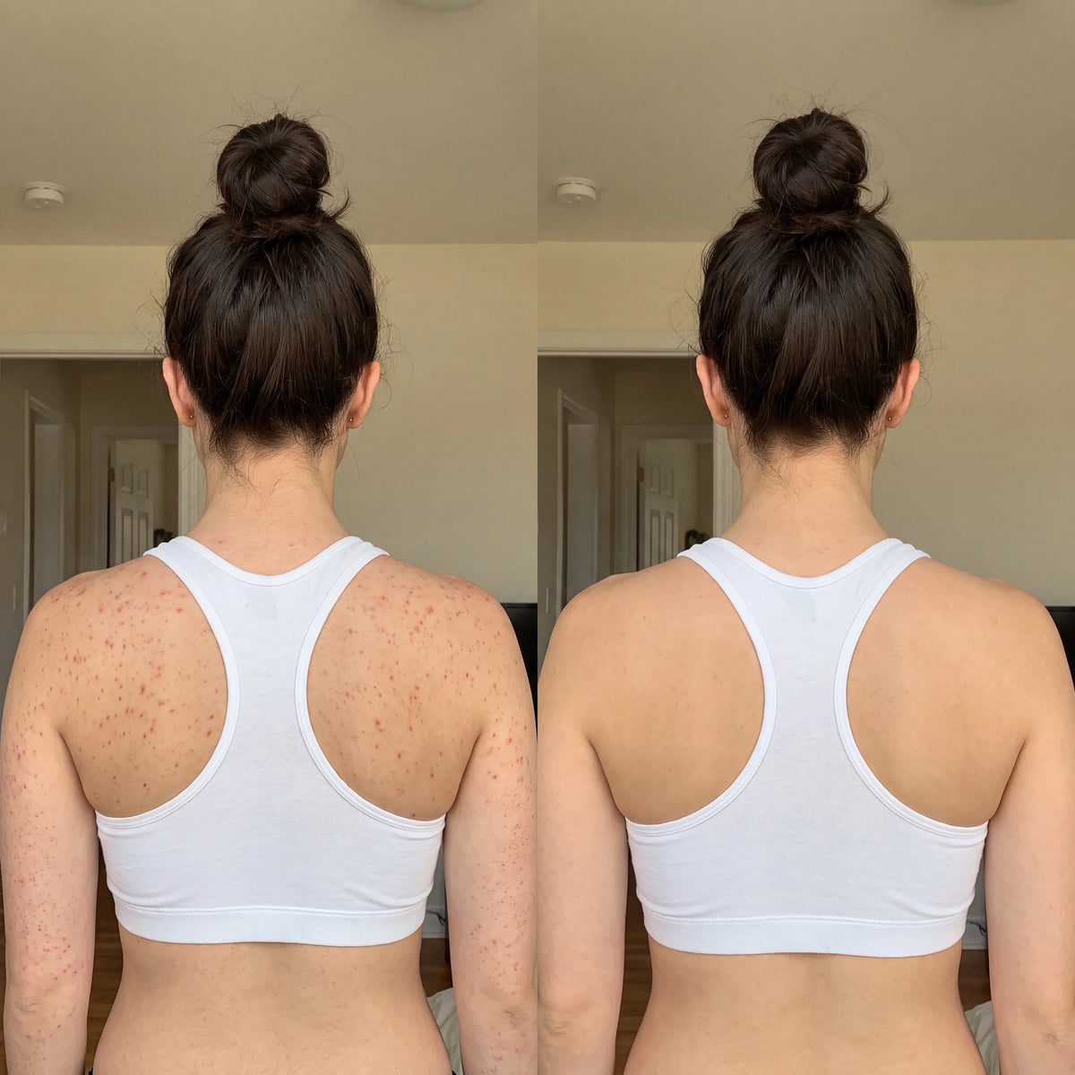 DERMAPURA® – Recuperá una piel lisa y libre de granitos.