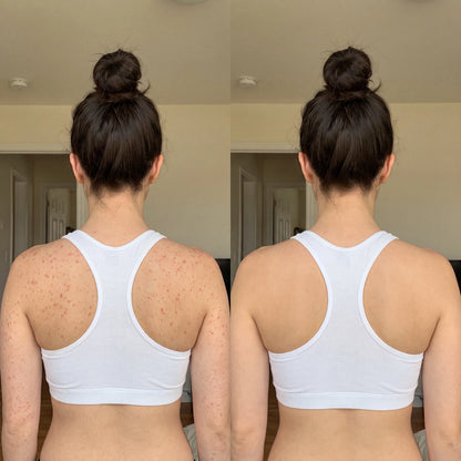 DERMAPURA® – Recuperá una piel lisa y libre de granitos.